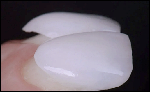 Laminates or Orthodontics: How to Choose for Gapped Front Teeth? image 10