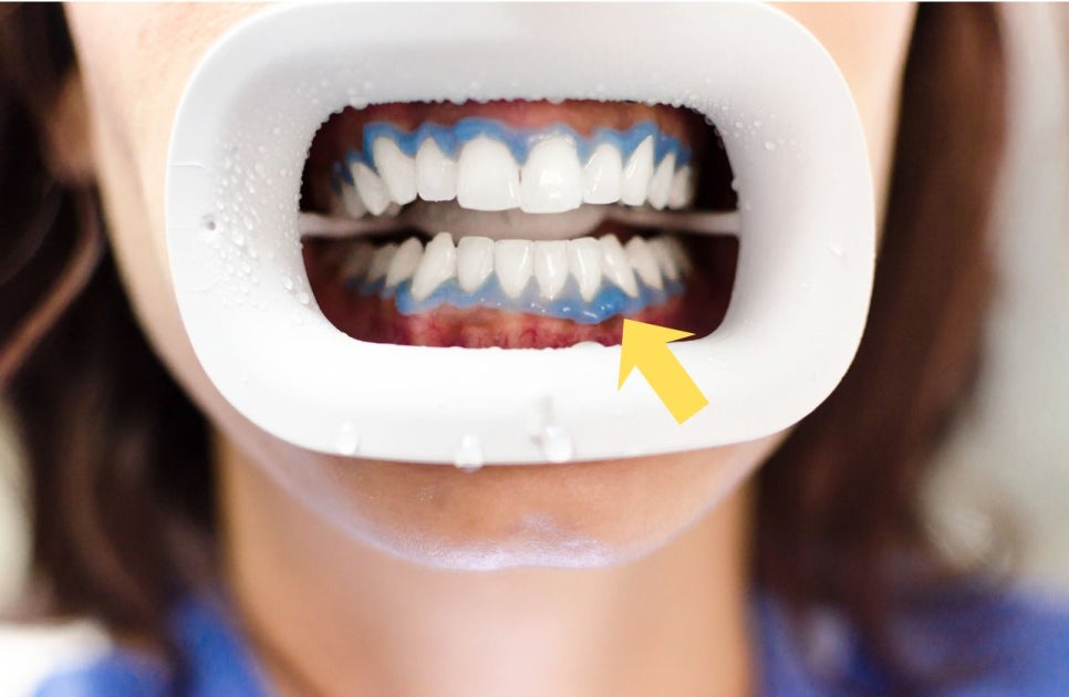 역삼동치아미백, 시작 전 이 2가지는 꼭 확인하세요 (의사작성) 관련 이미지 7