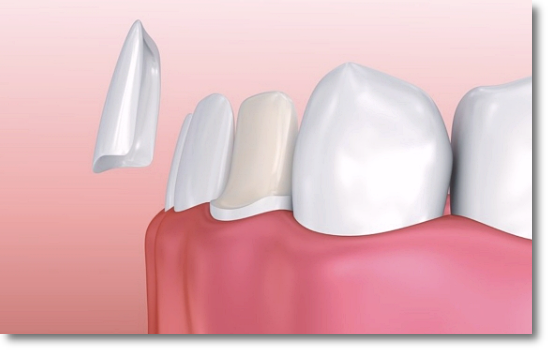 Three Characteristics of a Good Dental Clinic for Veneers in Seocho image 9