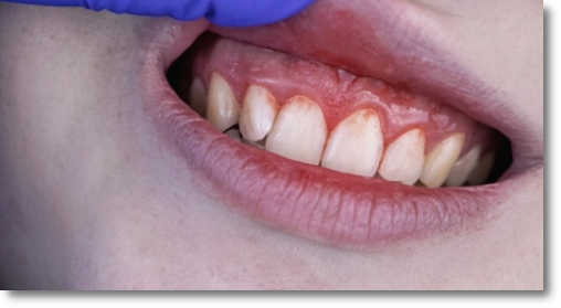 Gangnam One-Day Teeth Whitening Treatment Process and Duration image 5