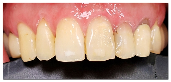 Swollen Gums: A Complete Guide to the Causes and Signs You Should Visit the Dentist image 11