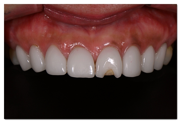 When Your Front Tooth Is Cracked, Do You Need to Visit the Dentist Immediately? (What to Check Before It Breaks) image 4
