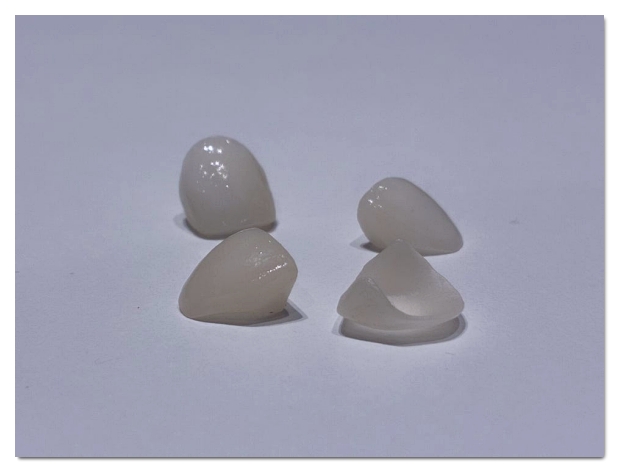 What to Do When a Laminate Veneer Breaks and the Treatment Approach image 5