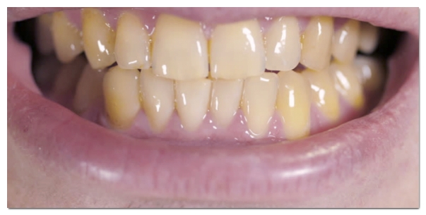 Why Teeth Turn Yellow and 4 Proper Ways to Address It image 3