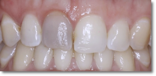 Gangnam One-Day Teeth Whitening Treatment Process and Duration image 7