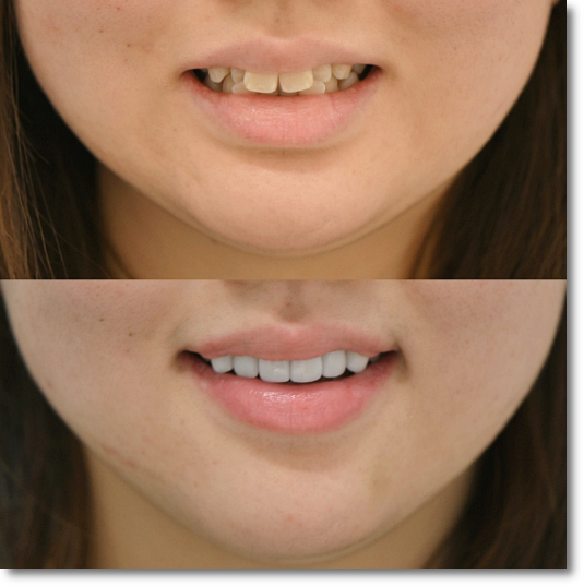 Gangnam One-Day Teeth Whitening Treatment Process and Duration image 9