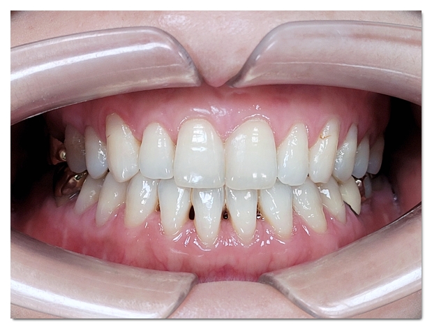 Black Triangles After Orthodontic Treatment: The Solution Depends on the Cause image 3