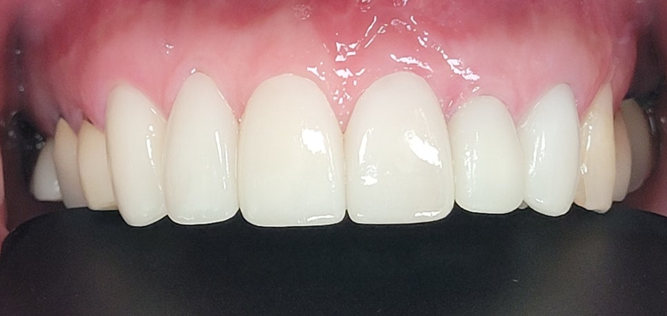 Improving Yellowed Front Teeth with Laminates: When Gum Treatment Is Needed Before Laminates image 7