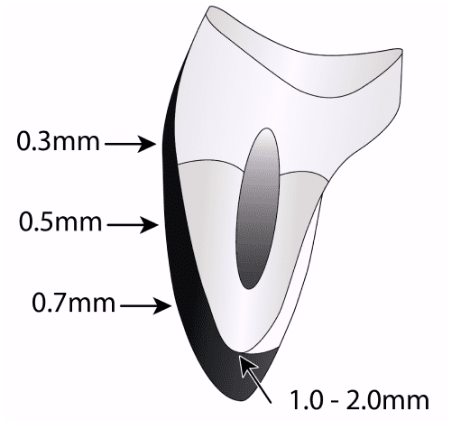 역삼동 앞니벌어짐, 브리네이트 vs 라미네이트 (의사조언) 관련 이미지 17