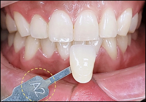 Laminates or Orthodontics: How to Choose for Gapped Front Teeth? image 7