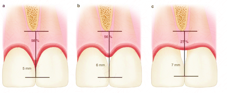 서초동치과, 앞니 사이가 까많게 보여요 <블랙트라이앵글 치료사례> 관련 이미지 5