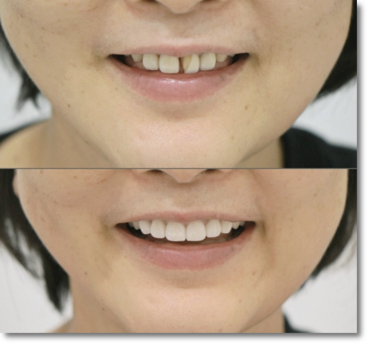 Can No-Prep Veneers Be Used on Every Tooth? image 8