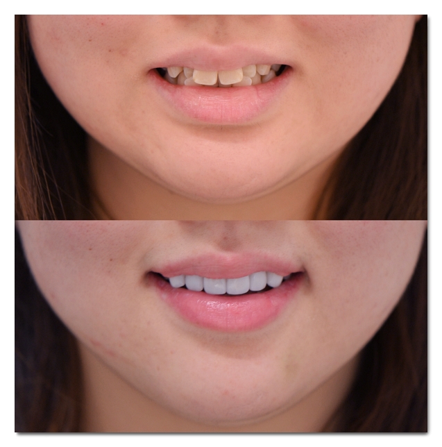 How to Whiten Yellow Teeth? Teeth Whitening vs. Veneers image 8