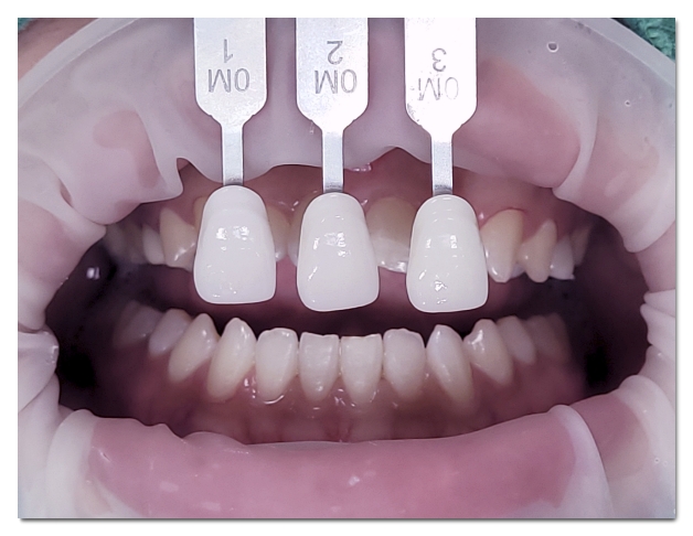 Teeth Whitening Costs, DIY Comparison, Procedure, Duration, and Care: A Complete Guide image 2