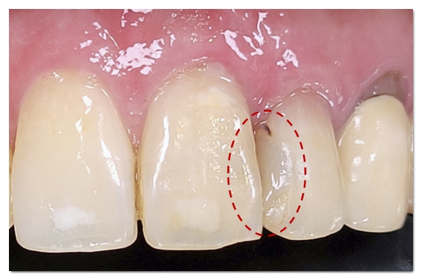 A Complete Guide to the Causes of Front Tooth Resin Discoloration and Solutions by Type image 6