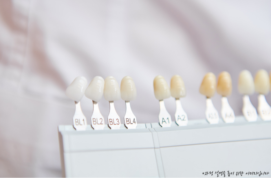 원진치과, 변색된 앞니 브리네이트로 티 안 나게 하는 2가지 기준 (의사조언) 관련 이미지 8