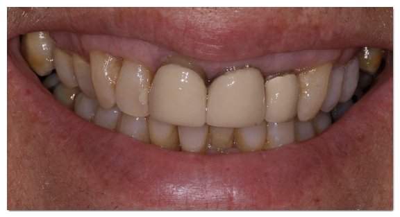 Why the Amount of Tooth Reduction for Veneers Determines Your Oral Health for Life image 4