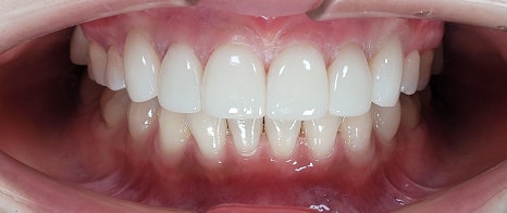 역삼동라미네이트, 결혼 앞두고 고민 중이라면? <필독> 관련 이미지 12