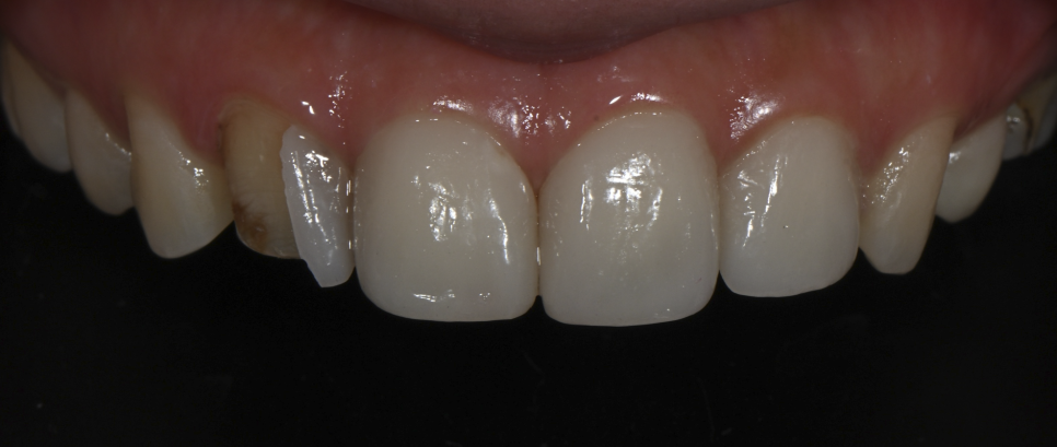 Laminates or Orthodontics: How to Choose for Gapped Front Teeth? image 9