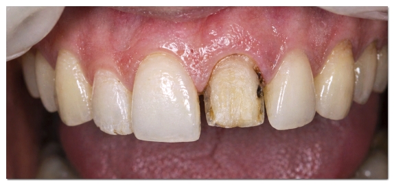 Why the Amount of Tooth Reduction for Veneers Determines Your Oral Health for Life image 10