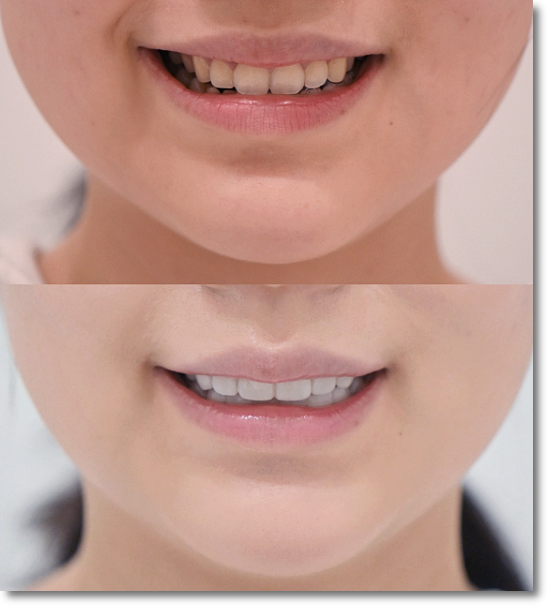Precautions to Know Before Undergoing Gum Contouring image 9
