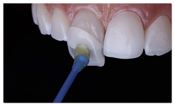 Can Malocclusion Be Treated with Veneers Without Orthodontics? image 3