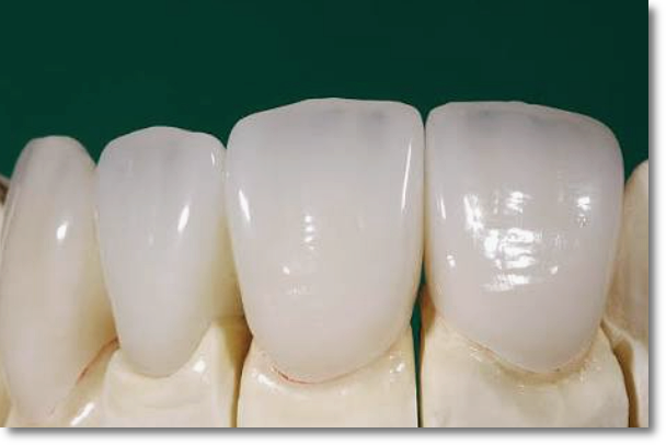 A Complete Guide to the Differences Between All-Ceramic, Zirconia, and PFM Dental Crowns image 6