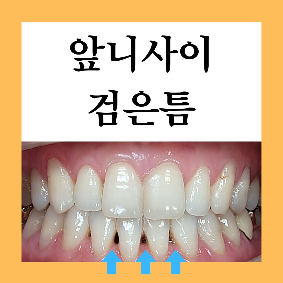 서초동치과, 앞니 사이가 까많게 보여요 <블랙트라이앵글 치료사례> 관련 이미지 2