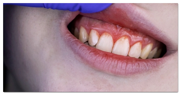 Swollen Gums: A Complete Guide to the Causes and Signs You Should Visit the Dentist image 7