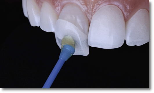 Gangnam One-Day Teeth Whitening Treatment Process and Duration image 10