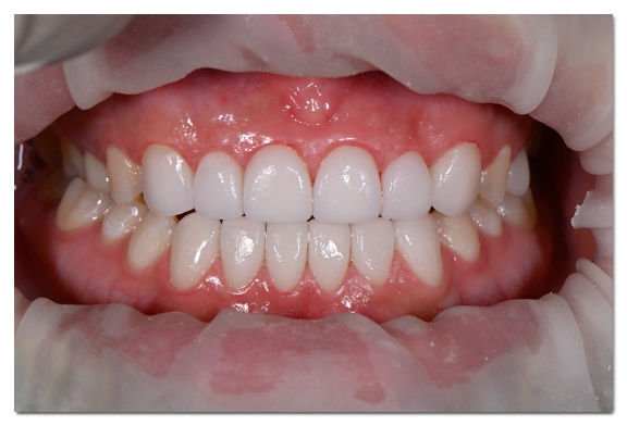 Can Malocclusion Be Treated with Veneers Without Orthodontics? image 8