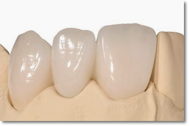 A Complete Guide to the Differences Between All-Ceramic, Zirconia, and PFM Dental Crowns image 4