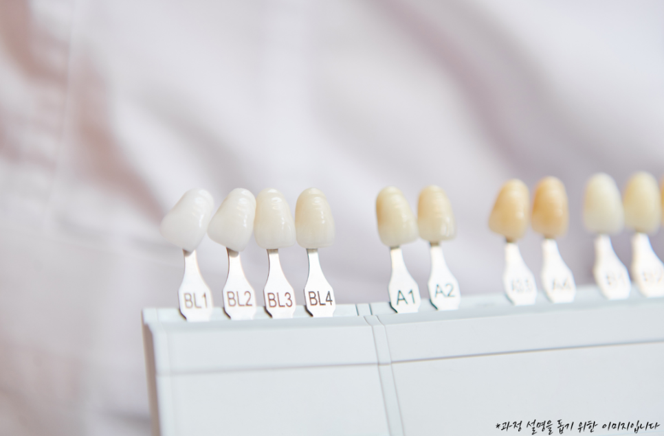 역삼동치아미백, 시작 전 이 2가지는 꼭 확인하세요 (의사작성) 관련 이미지 11