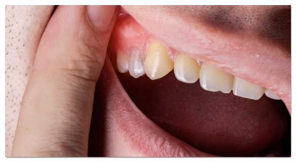 Swollen Gums: A Complete Guide to the Causes and Signs You Should Visit the Dentist image 4