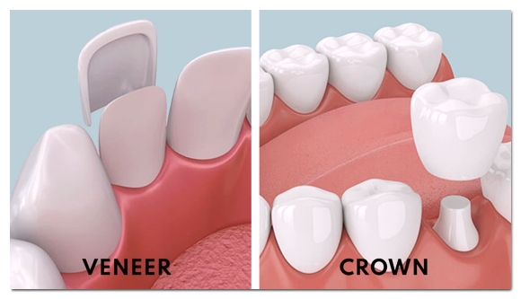 When Your Front Tooth Is Cracked, Do You Need to Visit the Dentist Immediately? (What to Check Before It Breaks) image 10