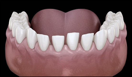 Laminates or Orthodontics: How to Choose for Gapped Front Teeth? image 5