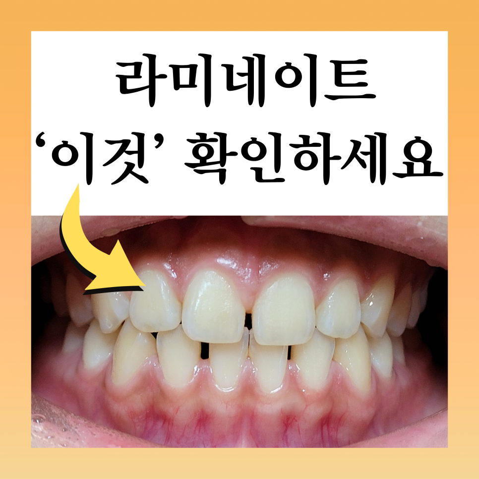 역삼동라미네이트, 결혼 앞두고 고민 중이라면? <필독> 관련 이미지 2