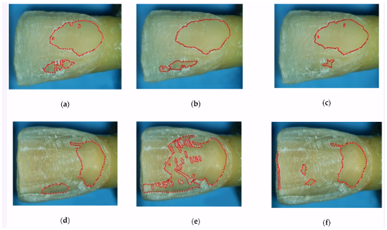 원진치과, 변색된 앞니 브리네이트로 티 안 나게 하는 2가지 기준 (의사조언) 관련 이미지 7