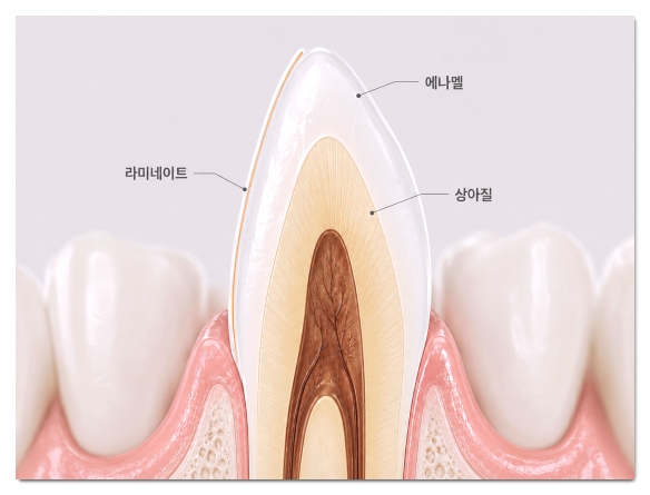 Why the Amount of Tooth Reduction for Veneers Determines Your Oral Health for Life image 6