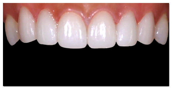 How Many Veneers Should You Get? Criteria for Making Your Choice image 2
