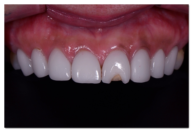 How to Choose a Good Laminate Dental Clinic Near Gangnam Station image 2