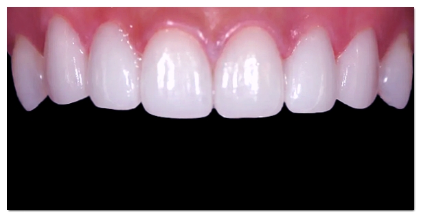 How Should You Choose a Laminate Veneer Dentist in Yeoksam-dong? image 8