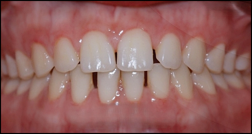 Laminates or Orthodontics: How to Choose for Gapped Front Teeth? image 3