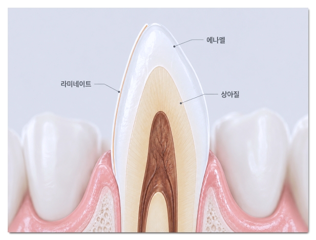 라미네이트 부작용 원인과 해결방법 (최소삭제가 중요한 이유) 관련 이미지 4