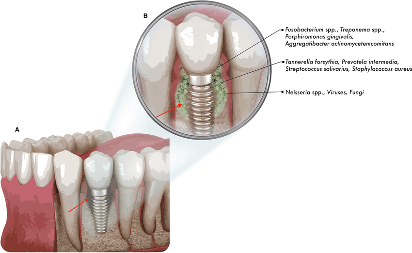 역삼동 앞니 임플란트 교체 신호 3가지 (의사작성) 관련 이미지 14