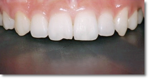 Gangnam One-Day Teeth Whitening Treatment Process and Duration image 8