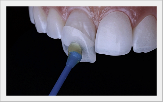 What to Look for When Choosing a Laminate Veneer Clinic image 4