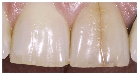 When Your Front Tooth Is Cracked, Do You Need to Visit the Dentist Immediately? (What to Check Before It Breaks) image 3