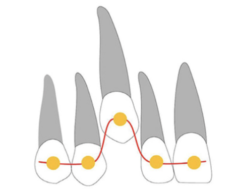서초동치과, 앞니 사이가 까많게 보여요 <블랙트라이앵글 치료사례> 관련 이미지 8