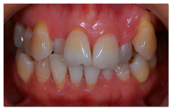 Why the Amount of Tooth Reduction for Veneers Determines Your Oral Health for Life image 7